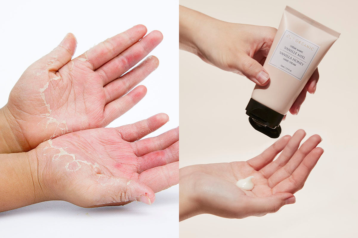 護手霜挑對了嗎? 乾裂脫皮反覆?異膚也能安心使用的關鍵成分大揭密!