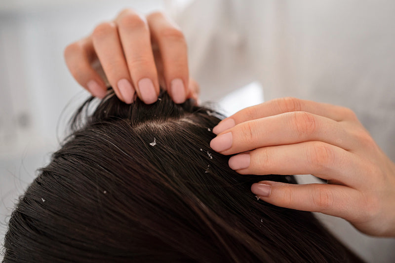 頭皮屑超級多、髮絲出油又掉髮！你的洗髮精可能選錯了