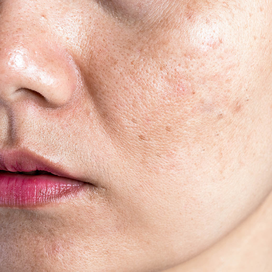 每天擦防曬，為什麼毛孔越來越粗？你可能踩了這 3 個地雷！